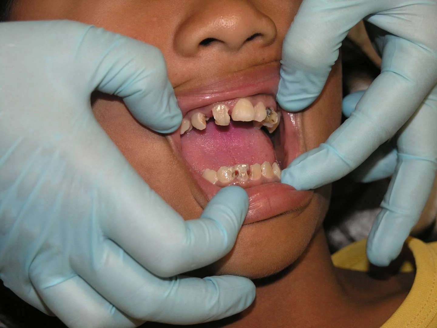 How to Prevent Common Dental Problems