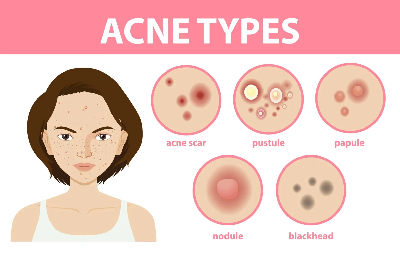 Understanding Acne: Different Types and Their Causes