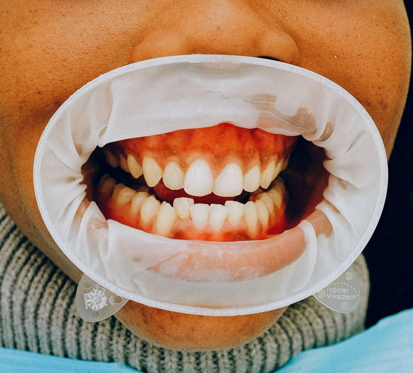 Understanding Gum Disease: Prevention and Treatment