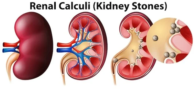 Battle of the Stones: The Comprehensive Guide to Dodging Kidney Stone