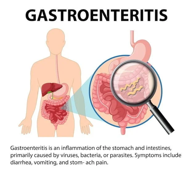 Navigating the Gastroenteritis Maze: Foods to Avoid