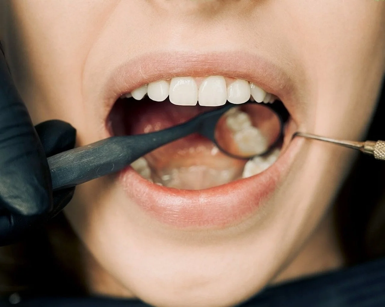 Protect Your Smile: Essential Tips to Prevent Tooth Decay