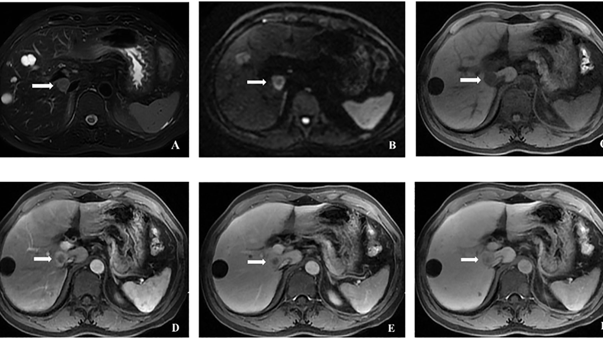 CT Imaging and Dual-Phenotype Hepatocellular Carcinoma (DPHCC): A Closer Look at Clinicopathologic Features