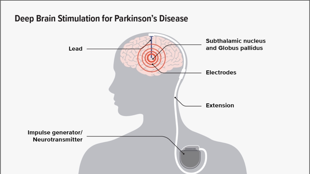 Advancements in Deep Brain Stimulation for Parkinson’s Disease: New Strategies Developed by Duke University Researchers