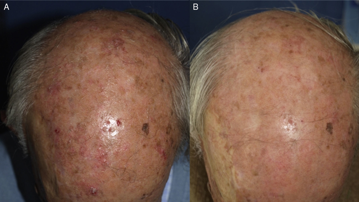 Seasonal and Geographical Factors Impact Photodynamic Therapy for Actinic Keratoses: A Comprehensive Study