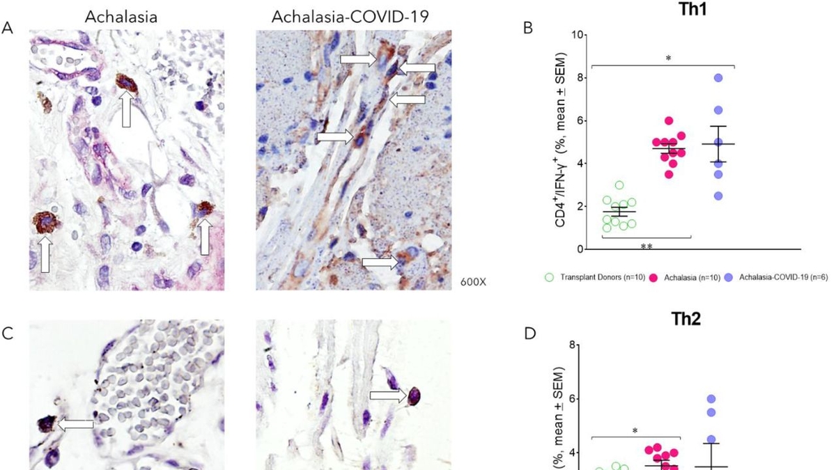 Exploring the Potential Connection Between SARS-CoV-2 and Achalasia