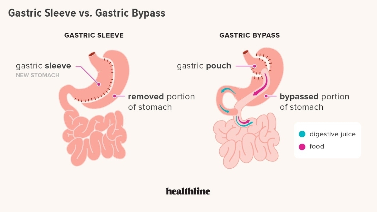 Perioperative Risks in Sleeve Gastrectomy vs Roux-en-Y Gastric Bypass: A Comparative Study