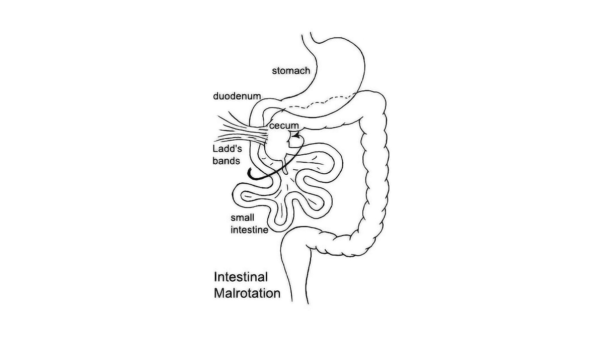 Uncovering the Potentials Causes of Intestinal Malrotation: Linking Atrazine and Metabolic Disruptions